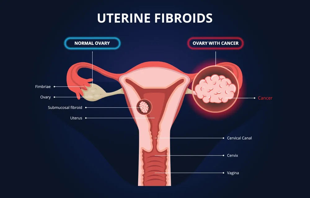 Ovarian Cancer Infographics or Uterine Fibroids