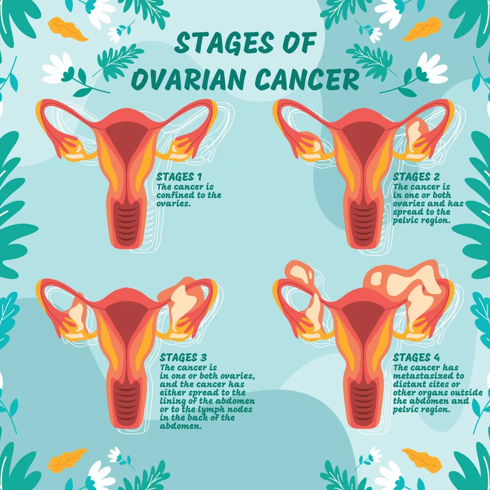 Ovarian Cancer Stage Infographic