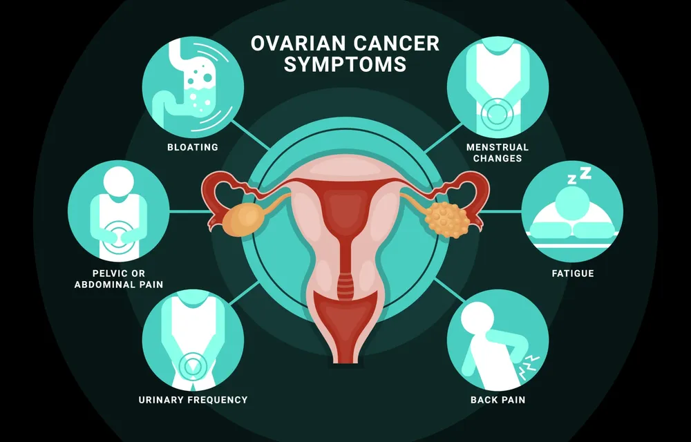 Ovarian Cancer Symptoms Infographic